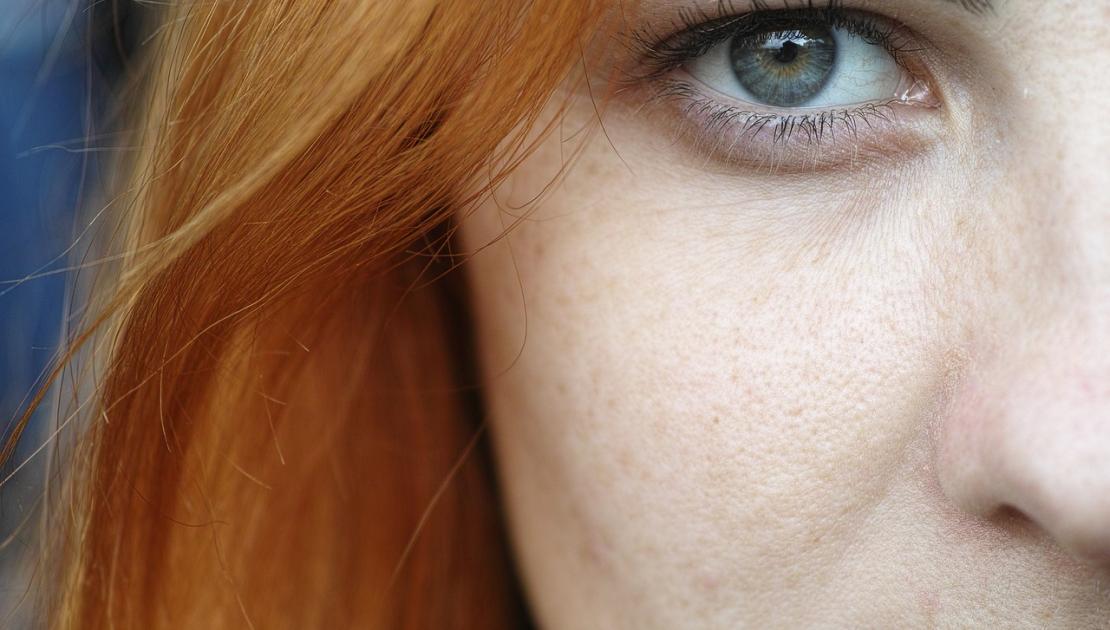 rousse peau grasse- pixabay