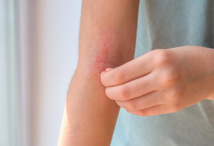 eczema atopique pli du coude